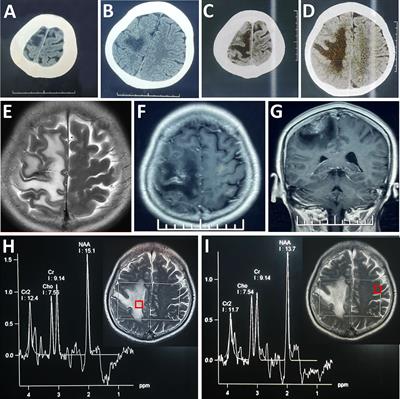 Case Report: Surgical thrombectomy in a patient with isolated cortical vein thrombosis previously misdiagnosed as brain tumor